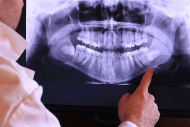 Best Emergency Dental Extractions in Ishpeng, MI