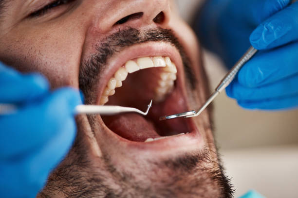 Best Emergency Root Canal Treatment in Ishpeng, MI
