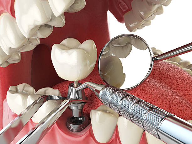 Best Emergency Dentist for Lost Fillings or Crowns in Ishpeng, MI